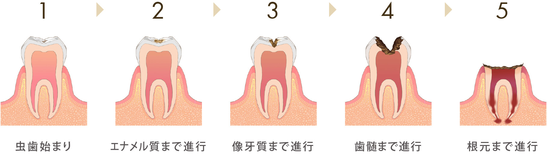 虫歯の原因