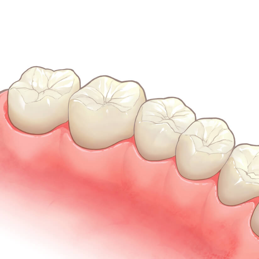 虫歯治療について