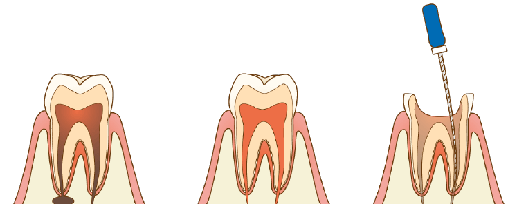 根管治療