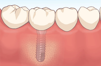 インプラント歯科