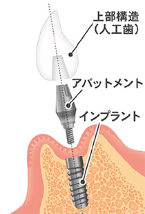 インプラントの基礎知識