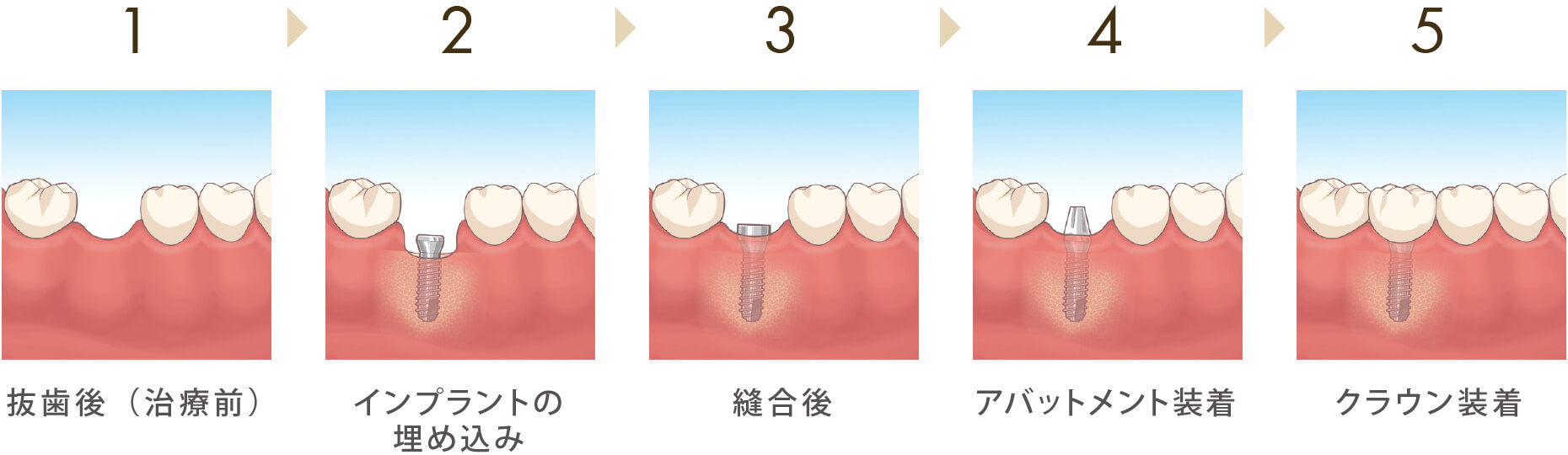 虫歯の原因