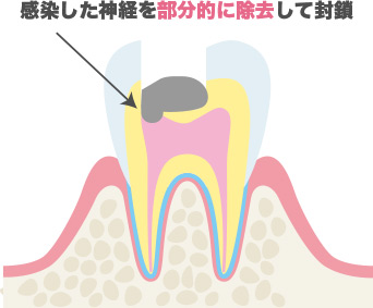 部分断髄法