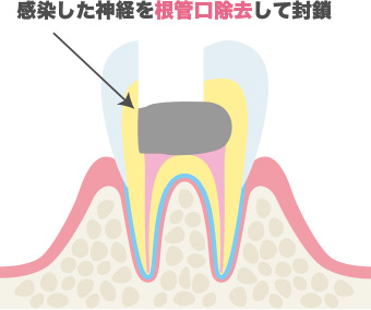 歯頚部断髄法